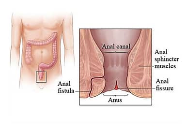 anal fistula surgery dubai