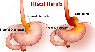 hiatus hernia surgery Dubai