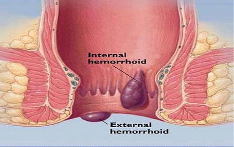 hemorrhoids Surgery Dubai